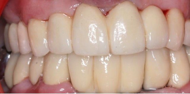 Zahnsituation nach Eingliederung des Zahnersatzes
