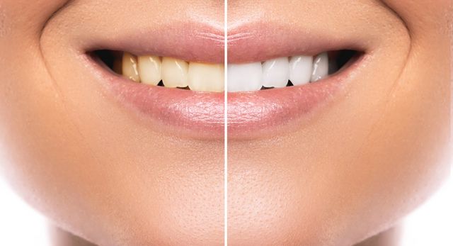 Zahnaufhellung Vergleich vorher nachher