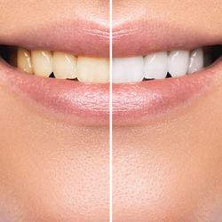Zahnaufhellung Vergleich vorher nachher